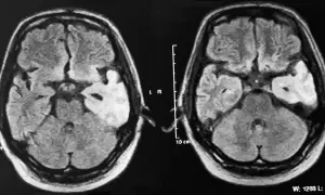 Obraz MRI mózgu ukazujący zmiany w płacie skroniowym, potencjalnie związane ze skutkami picia śniegu bez minerałów dla gospodarki elektrolitowej.
