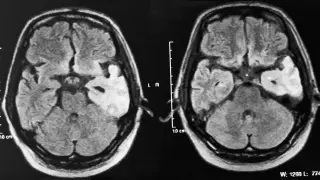 Obraz MRI mózgu ukazujący zmiany w płacie skroniowym, potencjalnie związane ze skutkami picia śniegu bez minerałów dla gospodarki elektrolitowej.