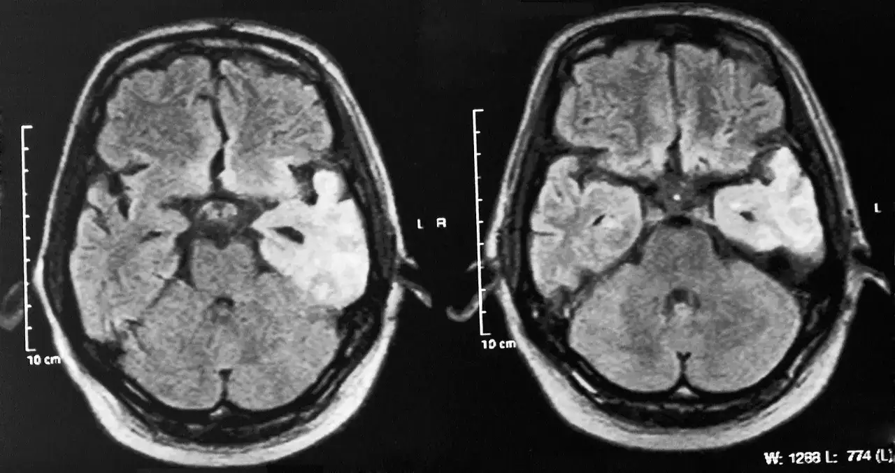 Obraz MRI mózgu ukazujący zmiany w płacie skroniowym, potencjalnie związane ze skutkami picia śniegu bez minerałów dla gospodarki elektrolitowej.